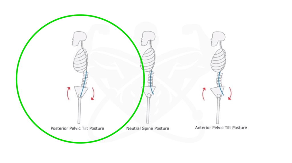 Posterior pelvic tilt